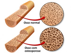 Materia - Osteoporose
